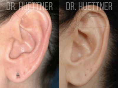 Earlobe Repair before and after photo