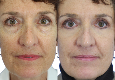 Eyelid Surgery before and after photo