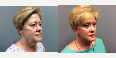 Facelift before and after photo