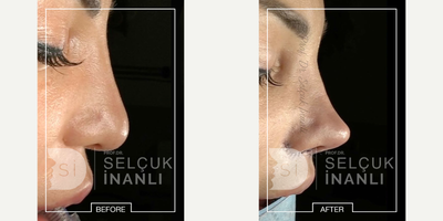 Facelift before and after photo