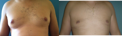 Gynecomastia Surgery before and after photo