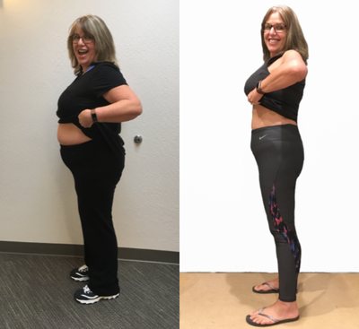 Orbera Gastric Balloon before and after photo