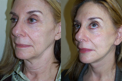 SMAS Facelift before and after photo