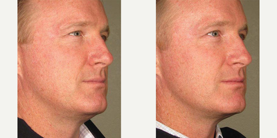 Ultherapy before and after photo