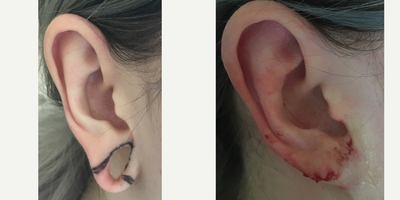 Earlobe Repair before and after photo