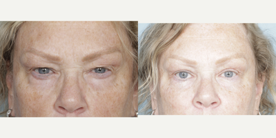 Eyelid Surgery before and after photo