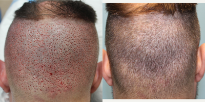 FUE Hair Transplant before and after photo