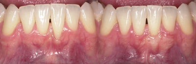 Gum Lift before and after photo