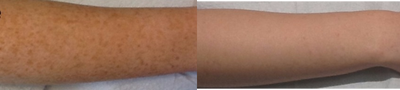 IPL before and after photo