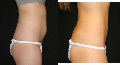 Liposuction before and after photo