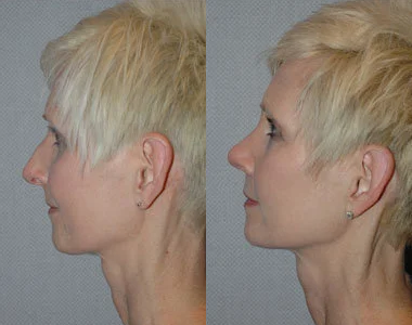 Rhinoplasty before and after photo