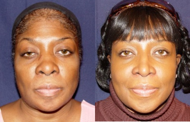 African American Rhinoplasty before and after photo