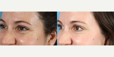 Botox before and after photo