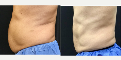 CoolSculpting before and after photo