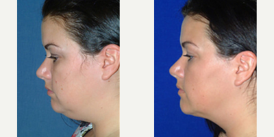 Facelift before and after photo