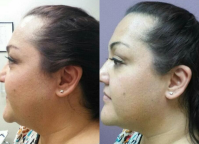 Kybella before and after photo