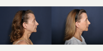 Neck Lift before and after photo