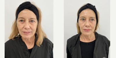 before and after image