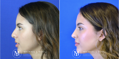 Rhinoplasty before and after photo