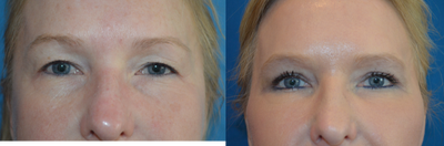 Eyelid Surgery before and after photo