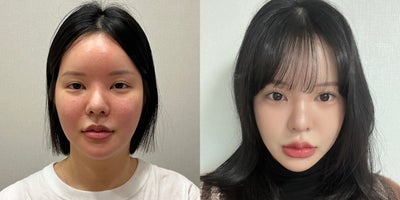 Facial Fat Transfer before and after photo