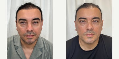 Ptosis Surgery before and after photo