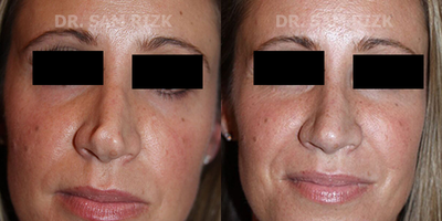 Revision Rhinoplasty before and after photo