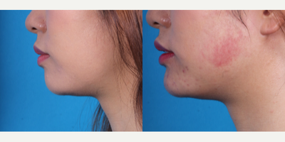 Chin Filler before and after photo
