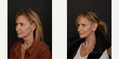 Deep Plane Facelift before and after photo