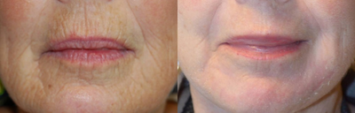 Dermabrasion before and after photo