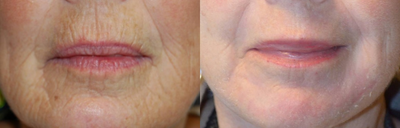 Dermabrasion before and after photo