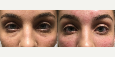 Eyelid Surgery before and after photo