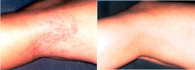IPL before and after photo