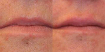 Juvederm before and after photo