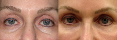 Restylane before and after photo