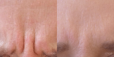 Botox before and after photo