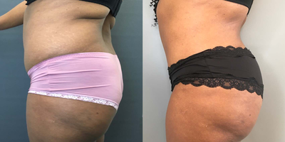 Brazilian Butt Lift before and after photo