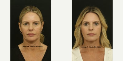 Eyelid Surgery before and after photo