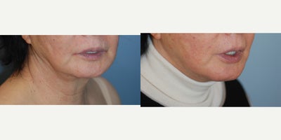 Facelift before and after photo