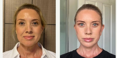 Facelift before and after photo
