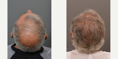 Hair Transplant before and after photo
