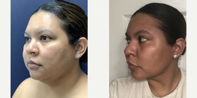 Liposuction before and after photo