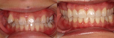 Invisalign before and after photo
