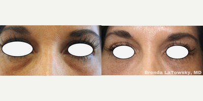 Restylane before and after photo