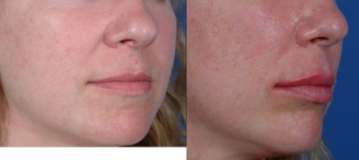 Volbella before and after photo