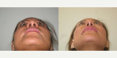 Asian Rhinoplasty before and after photo