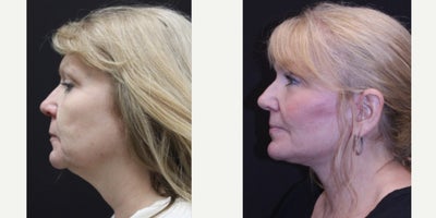 Facial Fat Transfer before and after photo