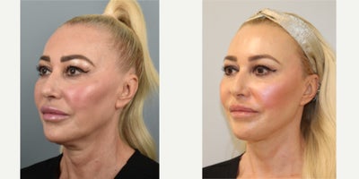 Fractional Laser before and after photo