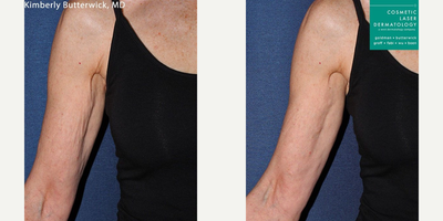 Radiesse before and after photo