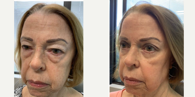 CO2 Laser before and after photo